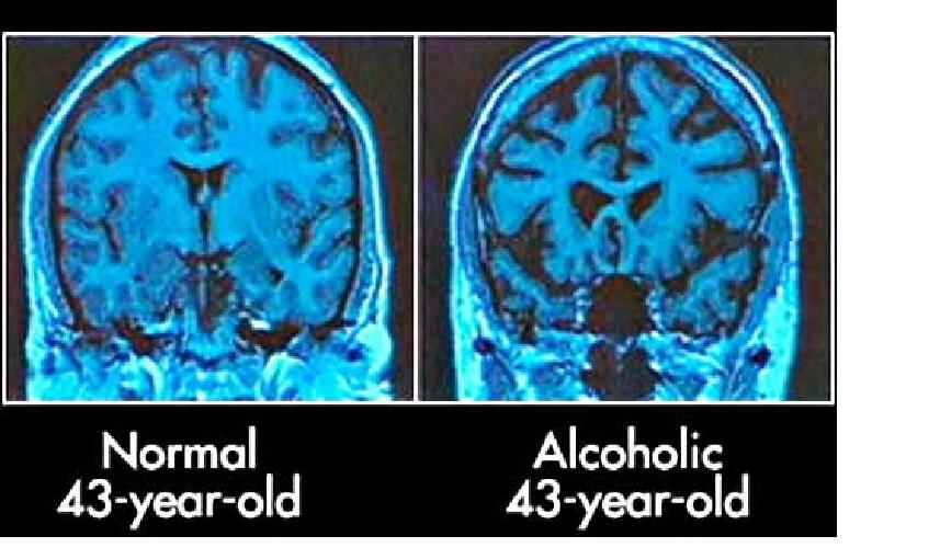 Healthy vs not brain